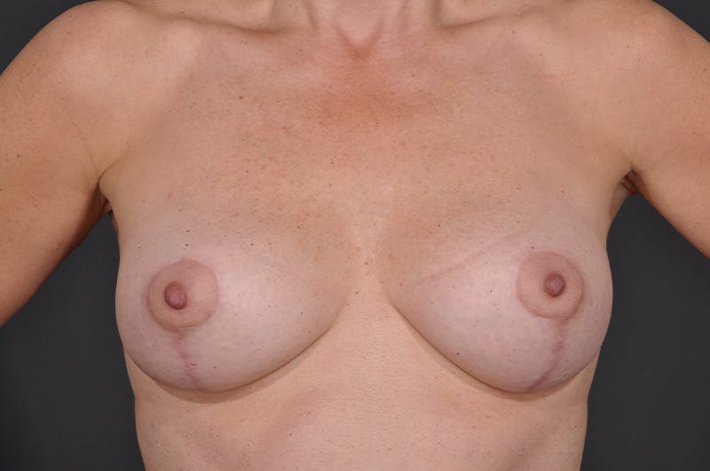 Breast Lift Before & After Gallery - Patient 711836 - Image 2