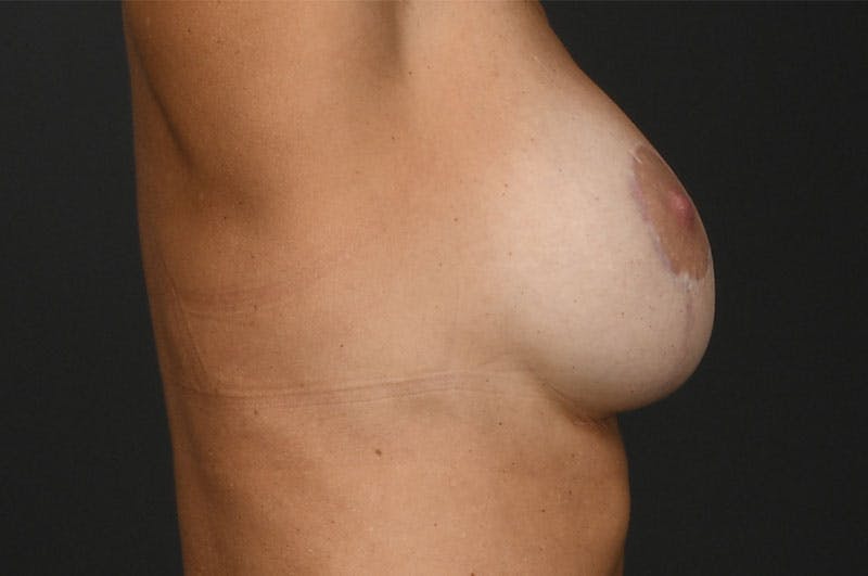 Breast Lift Before & After Gallery - Patient 377886 - Image 6