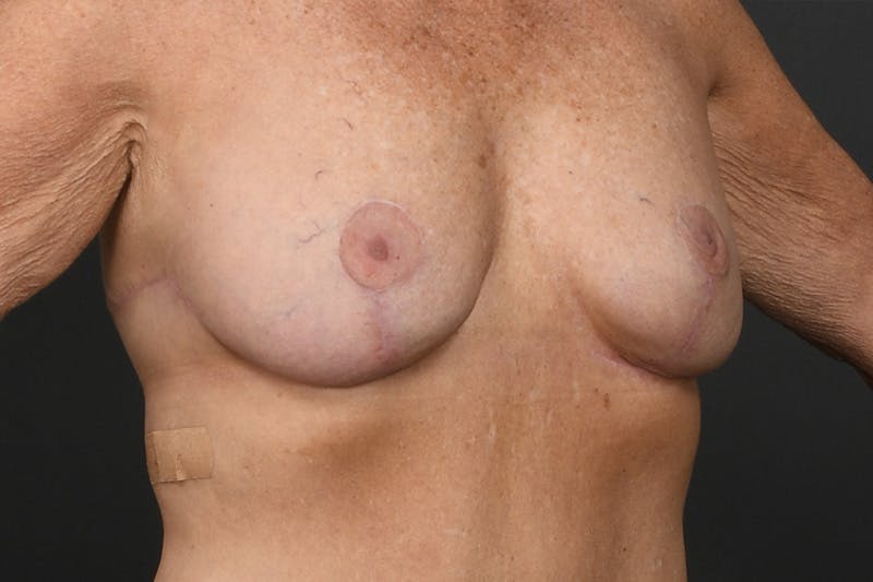 Breast Lift Before & After Gallery - Patient 126482 - Image 4