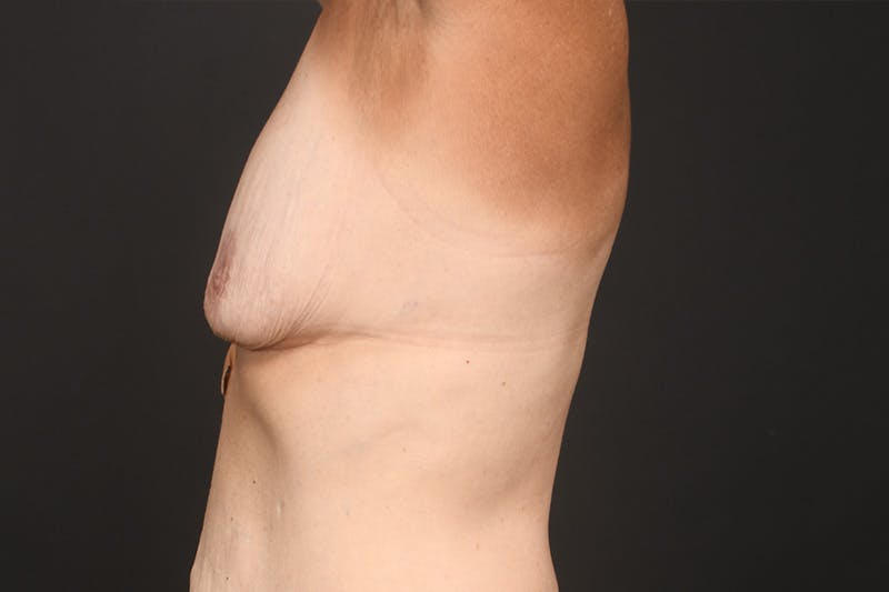 Breast Lift Before & After Gallery - Patient 126482 - Image 7