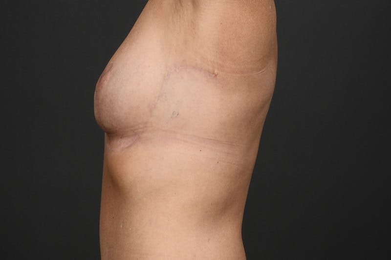 Breast Lift Before & After Gallery - Patient 126482 - Image 8