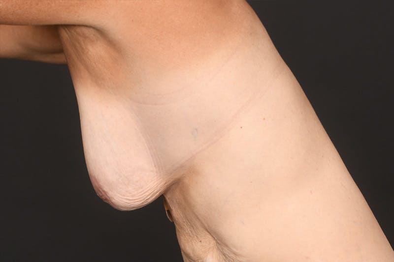 Breast Lift Before & After Gallery - Patient 126482 - Image 9