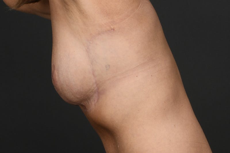 Breast Lift Before & After Gallery - Patient 126482 - Image 10