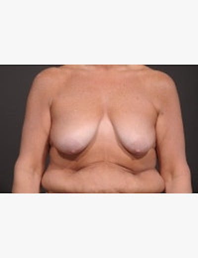 Breast Lift Before & After Gallery - Patient 150079 - Image 1