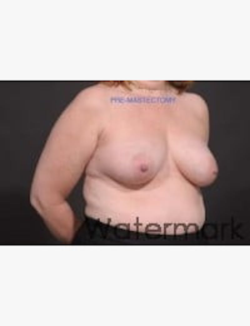 Breast Reconstruction Before & After Gallery - Patient 492368 - Image 2