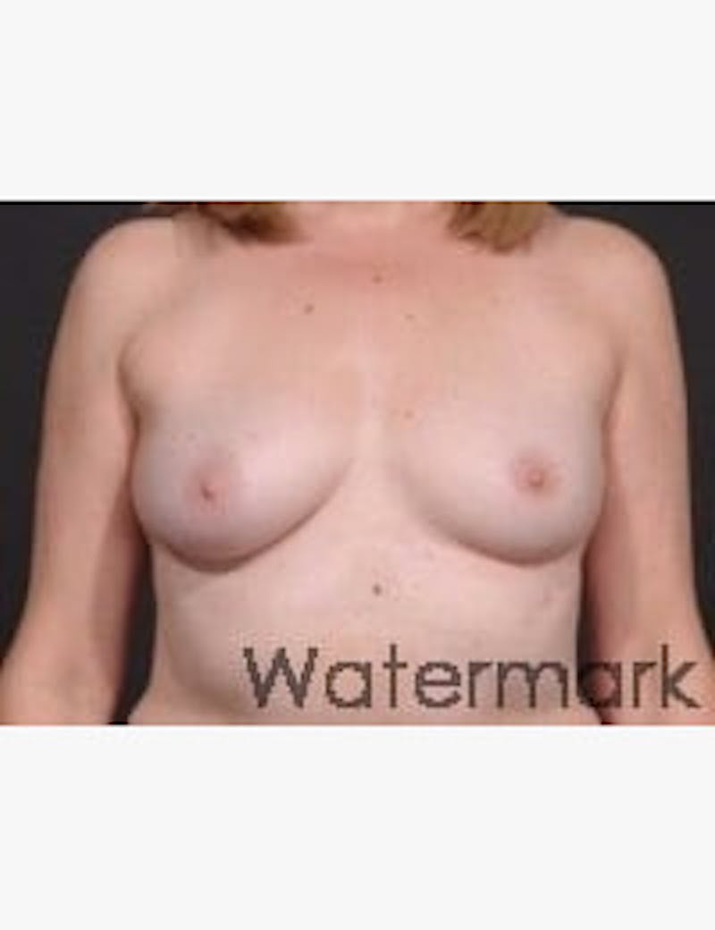 Breast Reconstruction Before & After Gallery - Patient 153964 - Image 1