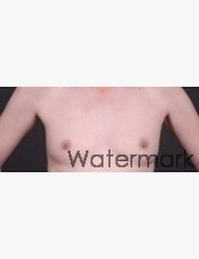 Breast Reconstruction Before & After Gallery - Patient 249332 - Image 1