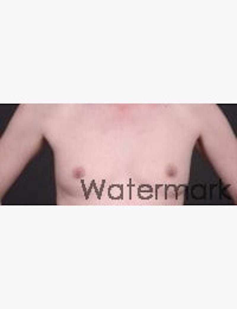 Breast Reconstruction Before & After Gallery - Patient 249332 - Image 1