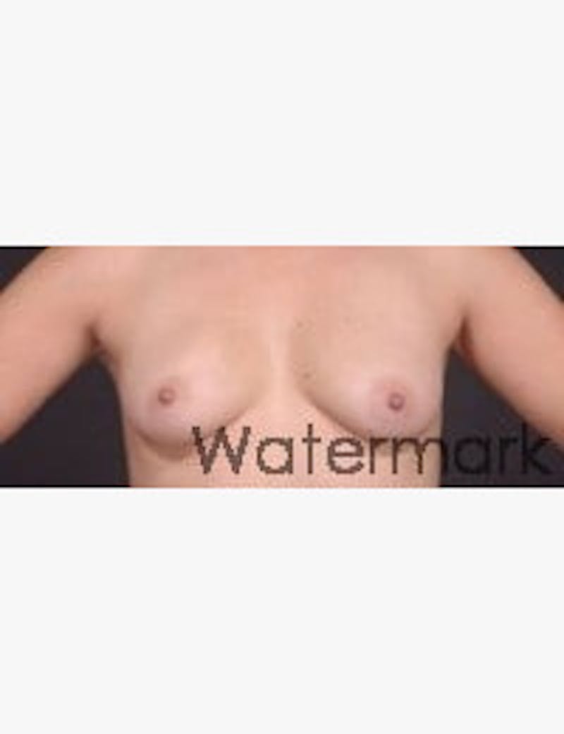 Breast Reconstruction Before & After Gallery - Patient 224786 - Image 1