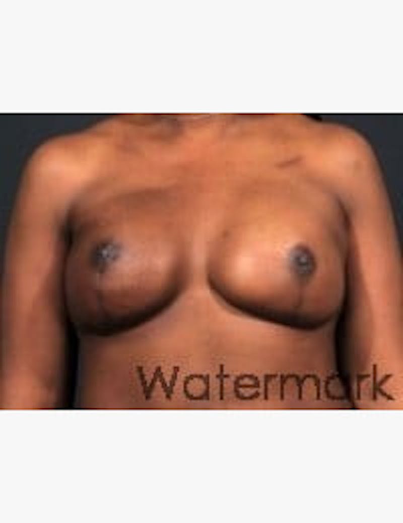 Breast Reconstruction Before & After Gallery - Patient 131184 - Image 2