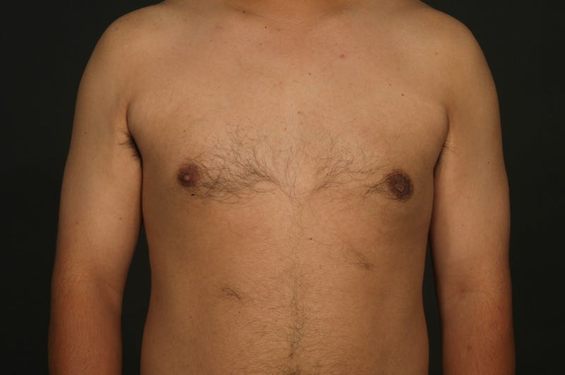 Male Gynecomastia Correction Before & After Gallery - Patient 331781 - Image 2