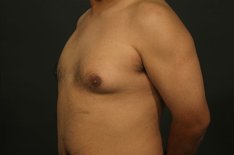 Male Gynecomastia Correction Before & After Gallery - Patient 331781 - Image 3