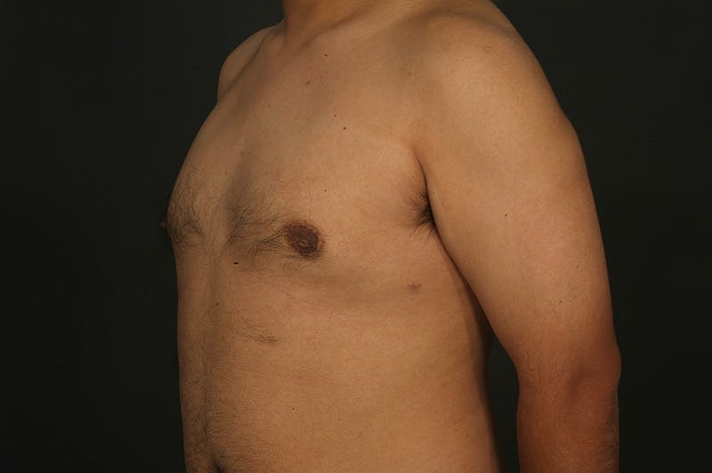 Male Gynecomastia Correction Before & After Gallery - Patient 331781 - Image 4