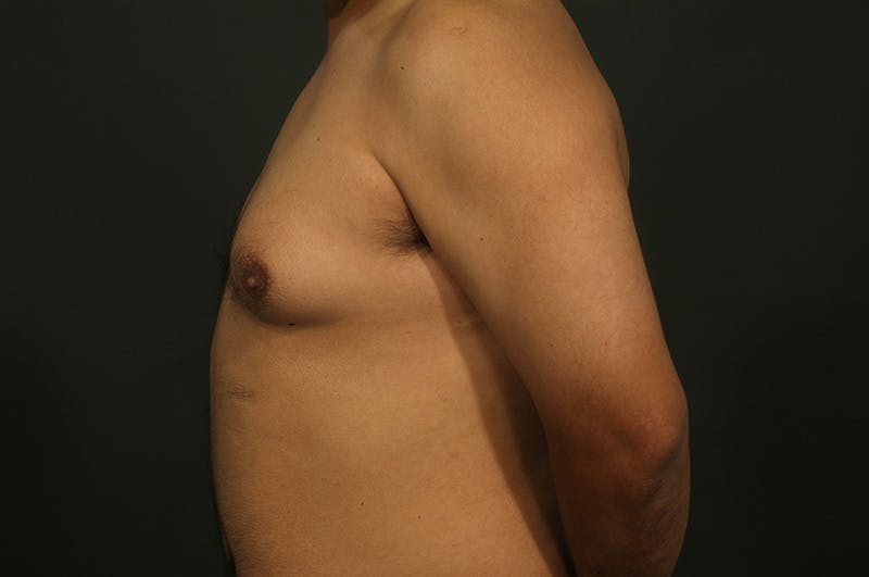 Male Gynecomastia Correction Before & After Gallery - Patient 331781 - Image 5