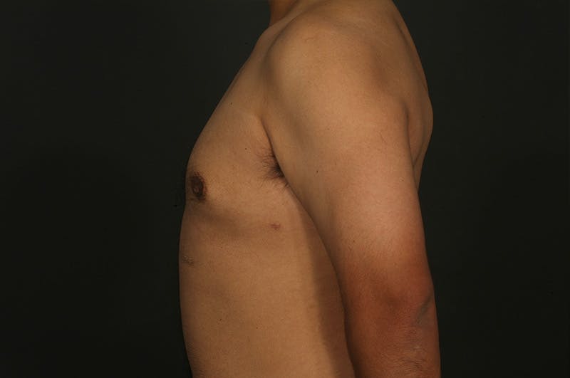 Male Gynecomastia Correction Before & After Gallery - Patient 331781 - Image 6