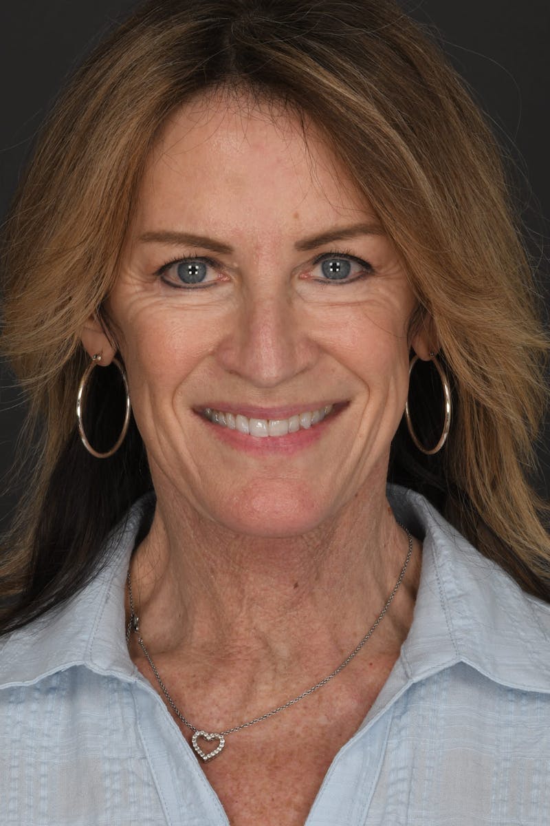 Composite Facelift Before & After Gallery - Patient 191034 - Image 4