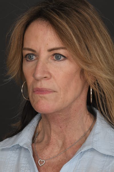 Composite Facelift Before & After Gallery - Patient 191034 - Image 2