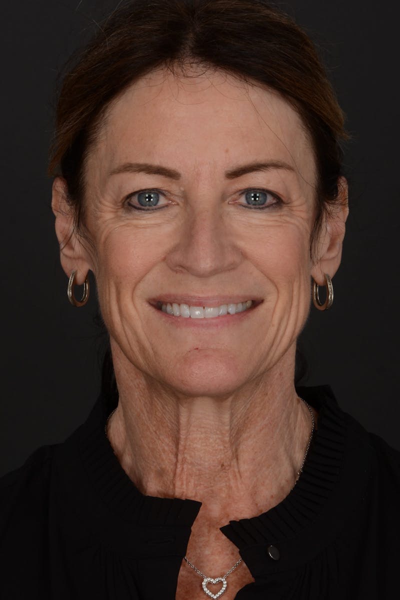 Composite Facelift Before & After Gallery - Patient 191034 - Image 3