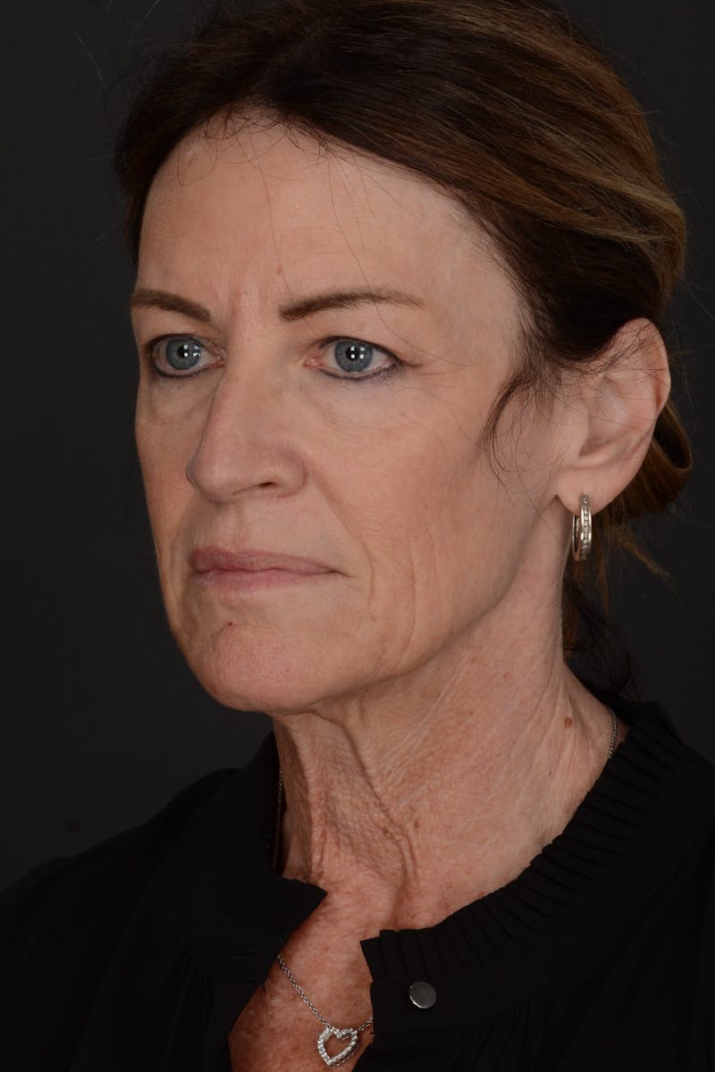 Composite Facelift Before & After Gallery - Patient 191034 - Image 1