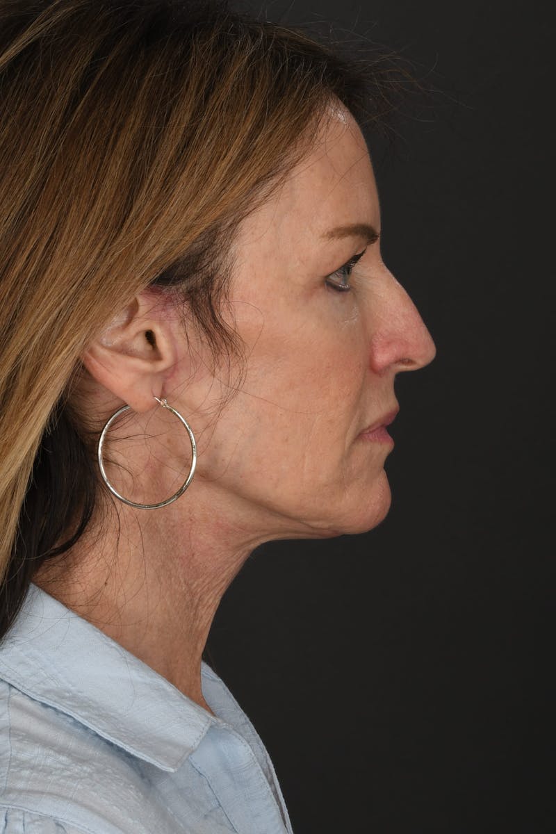 Composite Facelift Before & After Gallery - Patient 191034 - Image 6