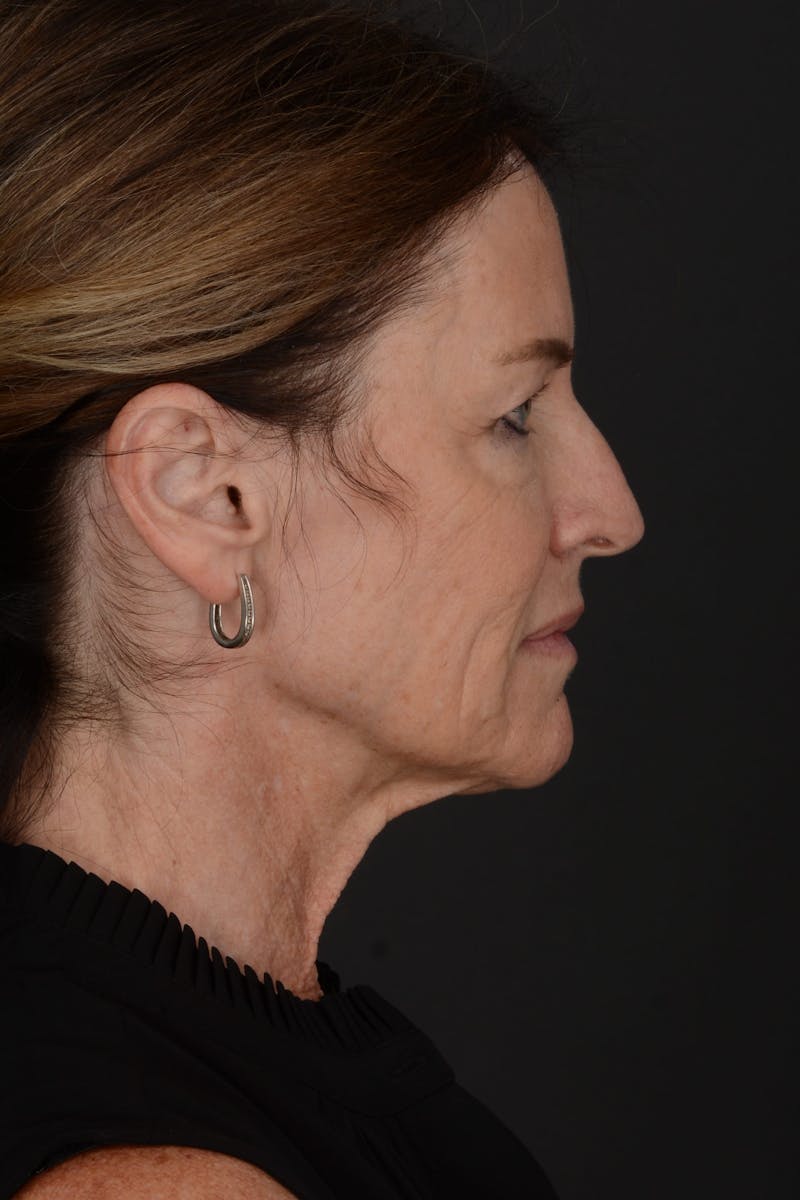 Composite Facelift Before & After Gallery - Patient 191034 - Image 5