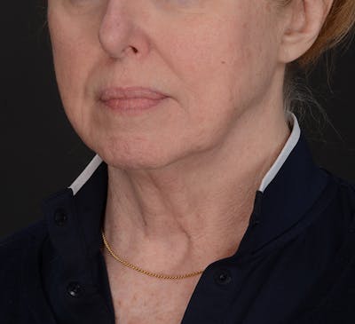 Facelift Before & After Gallery - Patient 452229 - Image 1