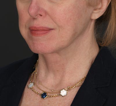 Facelift Before & After Gallery - Patient 452229 - Image 2