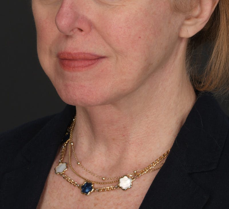 Neck Lift Before & After Gallery - Patient 189578 - Image 4