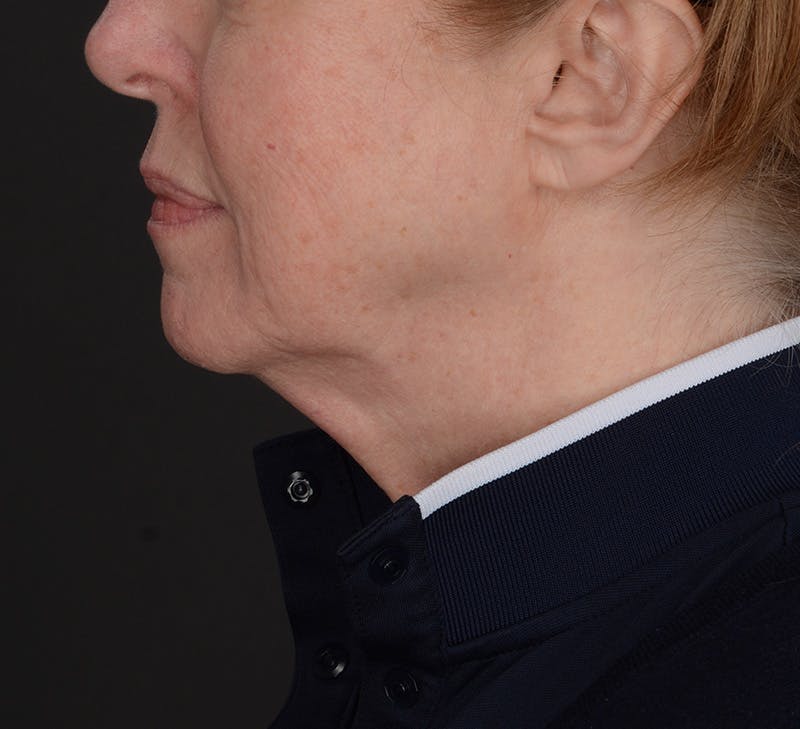 Neck Lift Before & After Gallery - Patient 189578 - Image 1