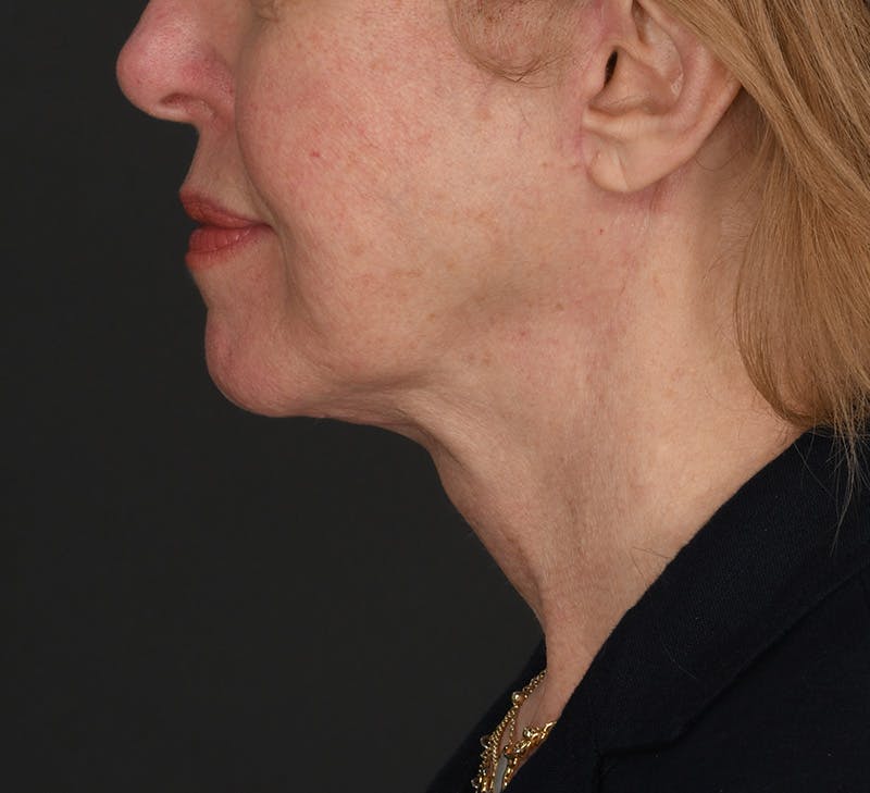 Neck Lift Before & After Gallery - Patient 189578 - Image 2