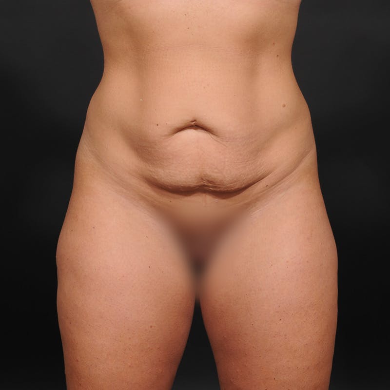 Tummy Tuck Before & After Gallery - Patient 221293 - Image 1