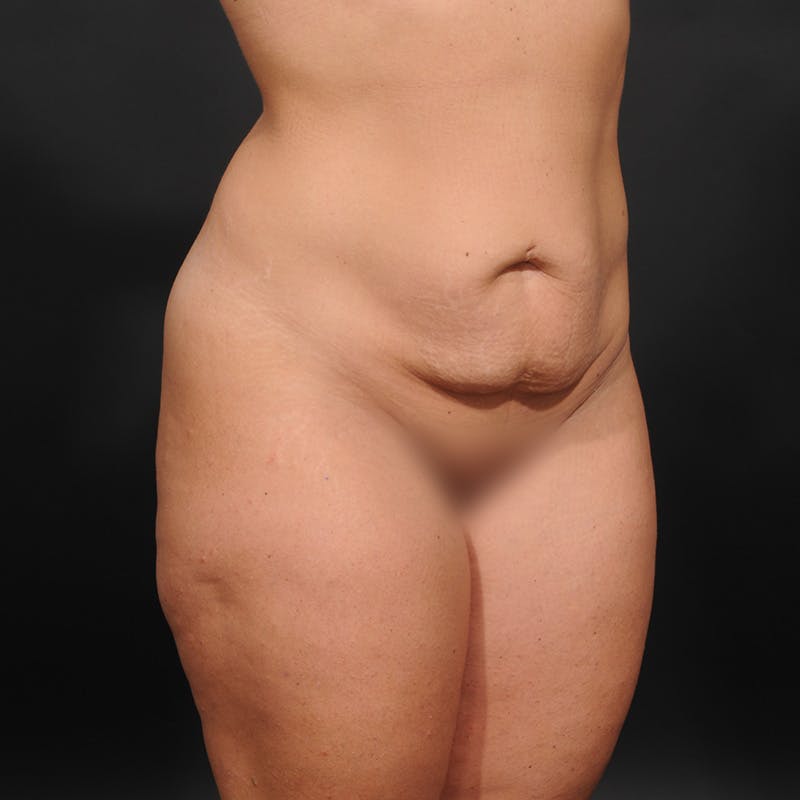 Tummy Tuck Before & After Gallery - Patient 221293 - Image 3