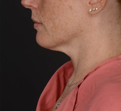 Neck Lift Before & After Gallery - Patient 401847 - Image 1