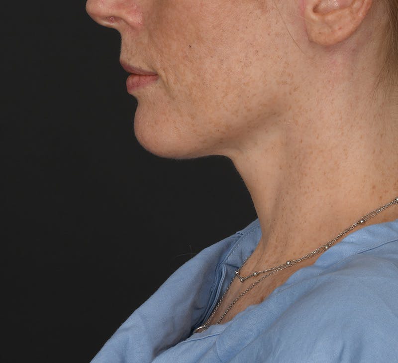 Neck Lift Before & After Gallery - Patient 401847 - Image 2