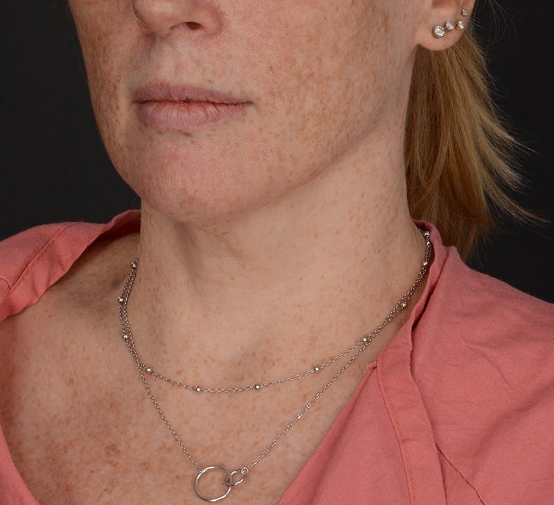 Neck Lift Before & After Gallery - Patient 401847 - Image 3