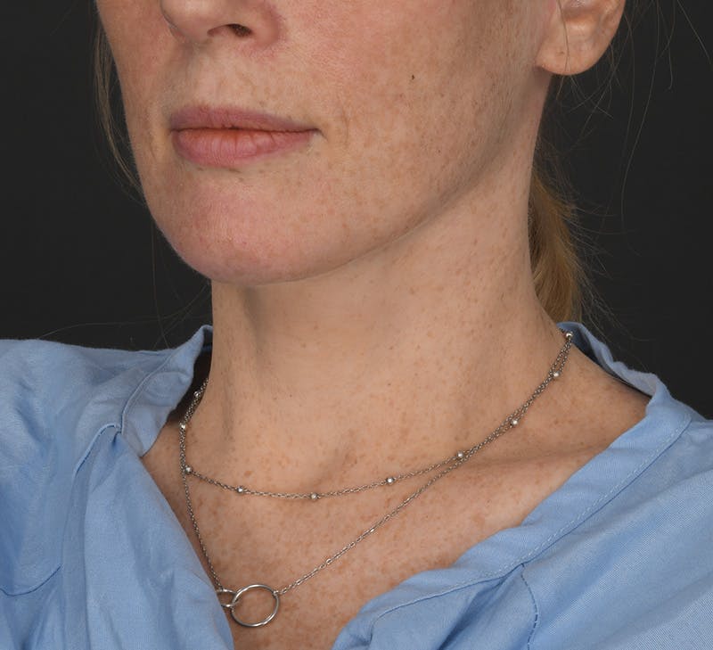 Neck Lift Before & After Gallery - Patient 401847 - Image 4