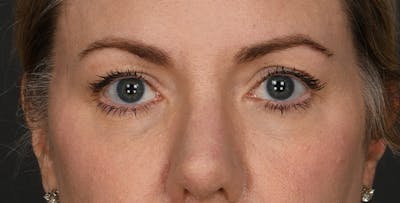 Blepharoplasty Before & After Gallery - Patient 879692 - Image 1
