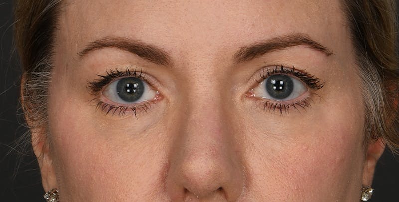 Blepharoplasty Before & After Gallery - Patient 879692 - Image 1
