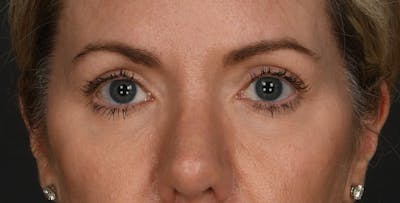 Blepharoplasty Before & After Gallery - Patient 879692 - Image 2