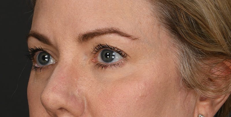 Blepharoplasty Before & After Gallery - Patient 879692 - Image 3