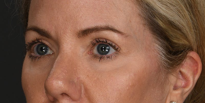 Blepharoplasty Before & After Gallery - Patient 879692 - Image 4