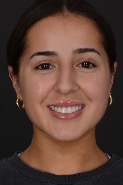 Rhinoplasty Before & After Gallery - Patient 394329 - Image 1