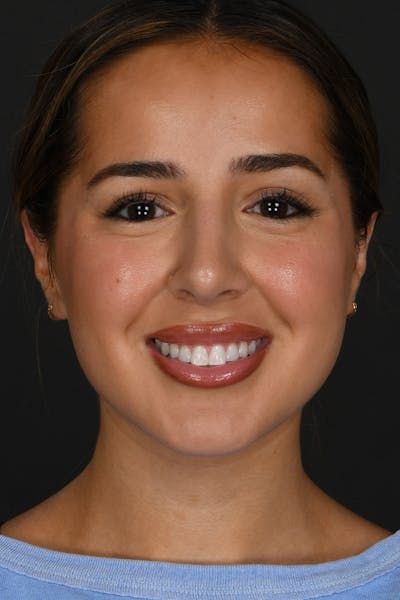 Rhinoplasty Before & After Gallery - Patient 394329 - Image 2