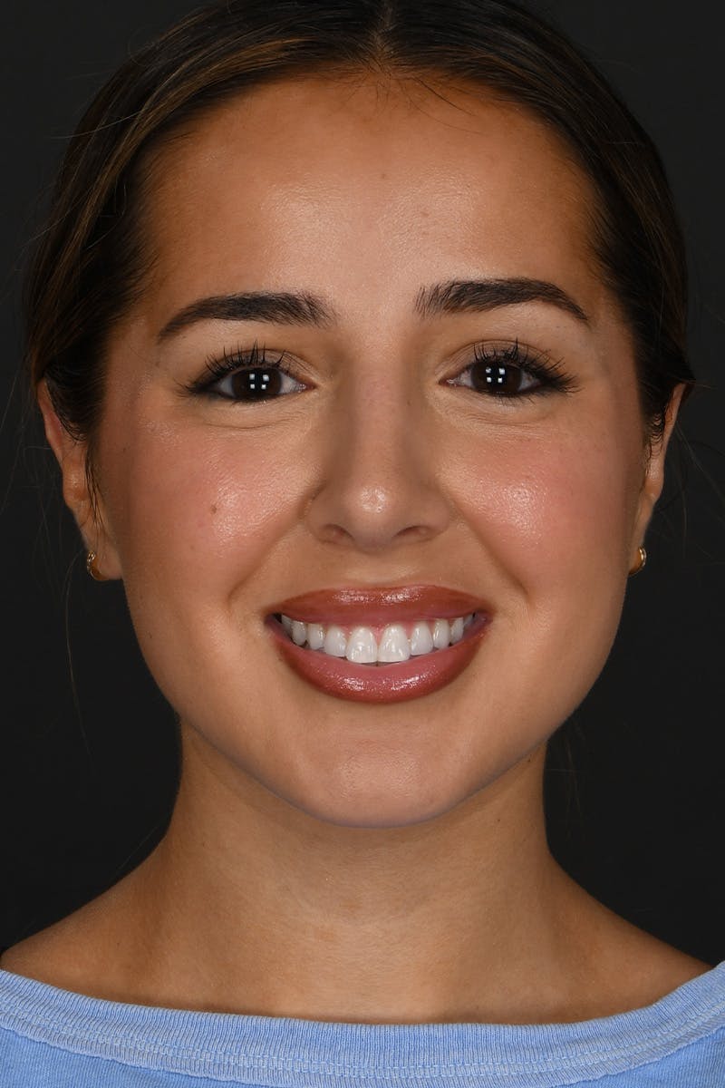 Rhinoplasty Before & After Gallery - Patient 394329 - Image 2