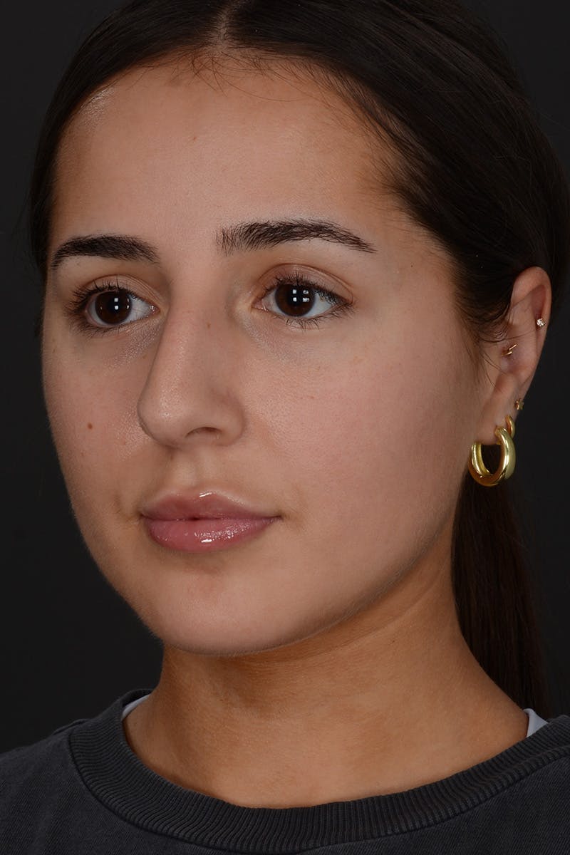 Rhinoplasty Before & After Gallery - Patient 394329 - Image 3