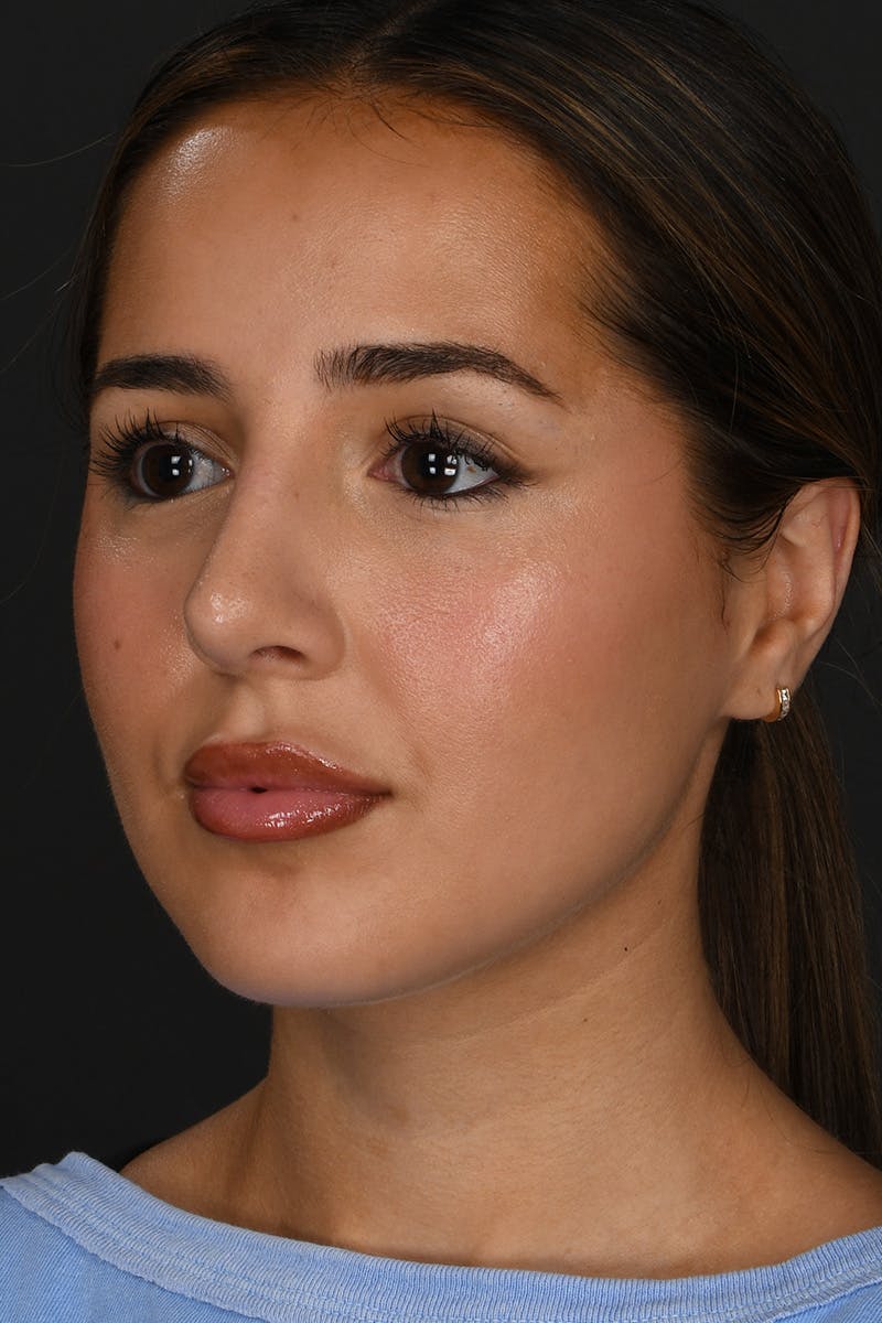 Rhinoplasty Before & After Gallery - Patient 394329 - Image 4
