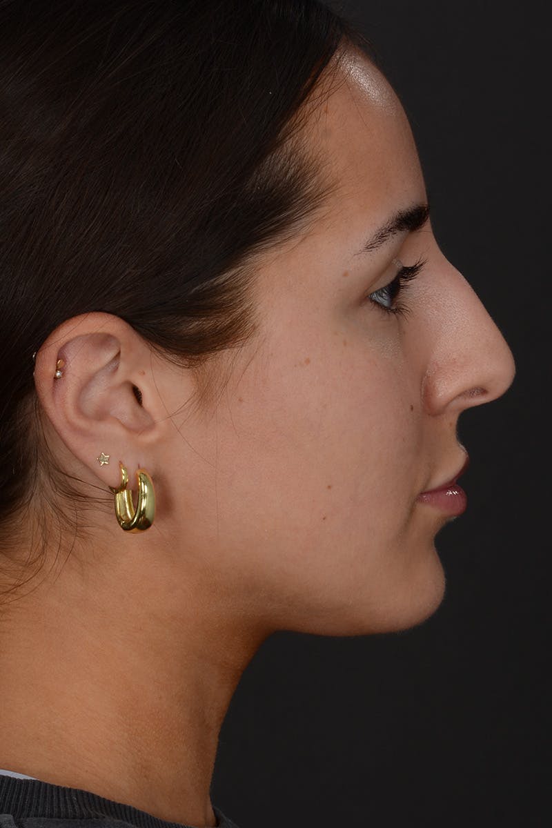 Rhinoplasty Before & After Gallery - Patient 394329 - Image 5