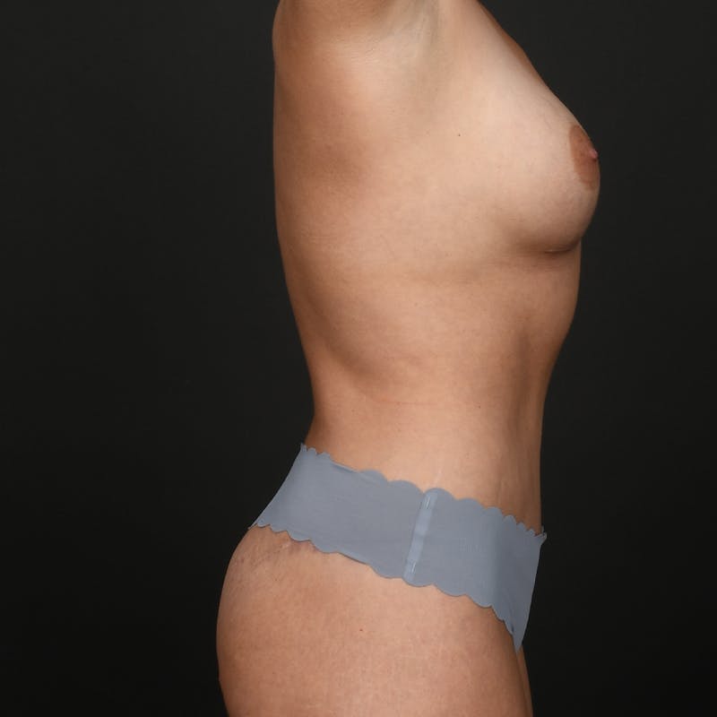 Mommy Makeover Before & After Gallery - Patient 536196 - Image 6