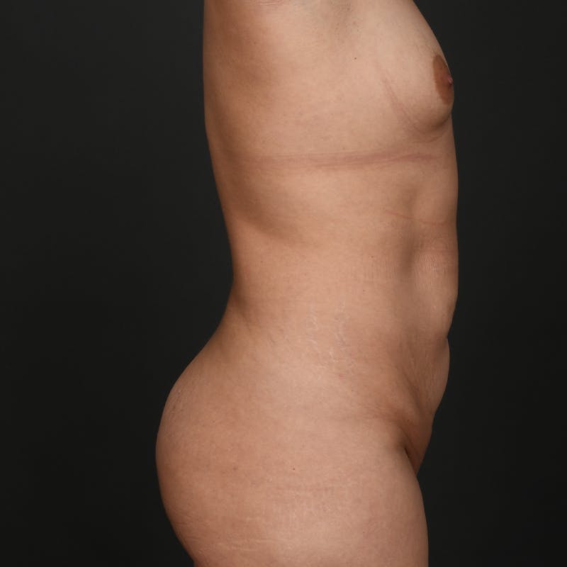 Mommy Makeover Before & After Gallery - Patient 536196 - Image 5