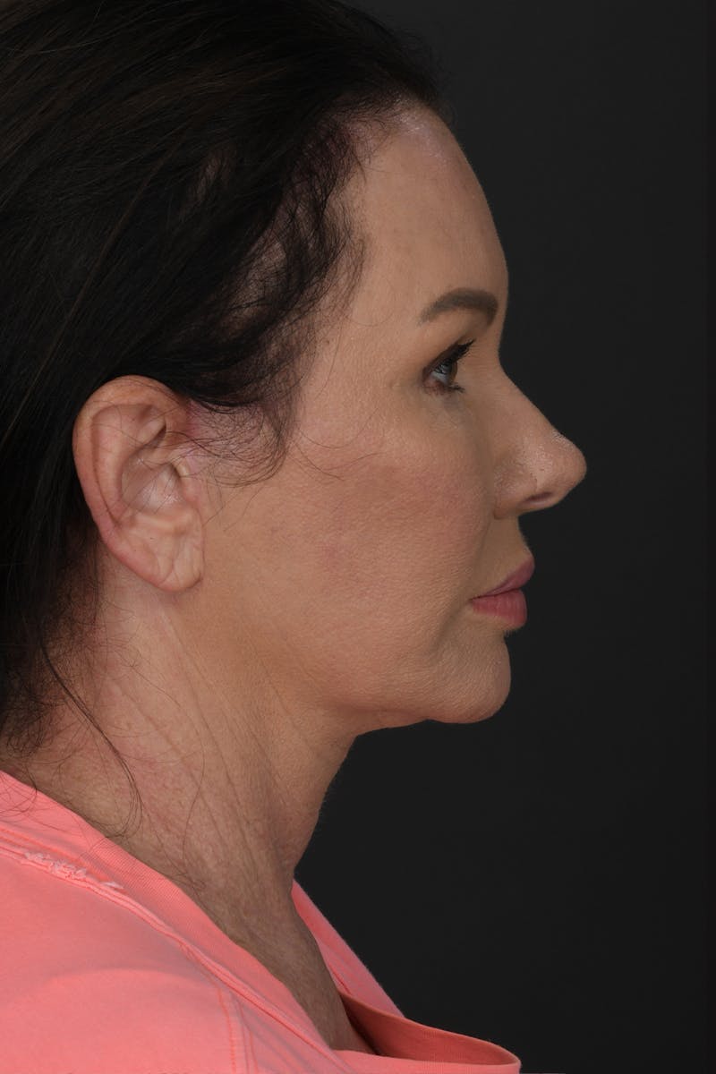 Brow Lift Before & After Gallery - Patient 180622 - Image 4